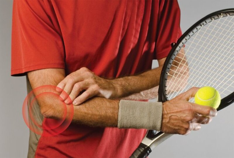 Tennis elbow là tình trạng đau khuỷu tay ngoài, thường liên quan đến việc dùng lực sai hoặc quá tải khi chơi. 